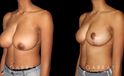 Procedures Depicted:  Breast Reduction