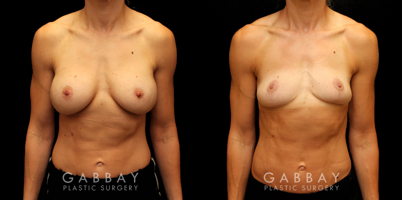 Procedures Depicted:  Implant removal/Mastopexy/Auto Augmentation