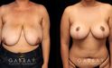 Patient 03 Front View Mastopexy Gabbay Plastic Surgery