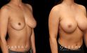 This is a breast augmentation patient who had significant asymmetry. She underwent silicone breast implant augmentation, using different sized high profile Allergan Natrelle Soft Touch implants: 365 cc on the left, 435 cc on the right. Implants were placed below the muscle in a dual plane configuration using an incision that is beautifully hidden within the breast fold.