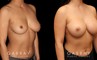 This is a breast augmentation patient who had significant asymmetry. She underwent silicone breast implant augmentation, using different sized high profile Allergan Natrelle Soft Touch implants: 365 cc on the left, 435 cc on the right. Implants were placed below the muscle in a dual plane configuration using an incision that is beautifully hidden within the breast fold.