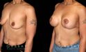 Procedures Depicted:  Breast Augmentation – Silicone & Lift