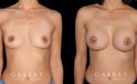 Patient result photos following silicone implant breast augmentation. Patient elected for a rounder shape with mild breast protrusion for subtle yet alluring results.