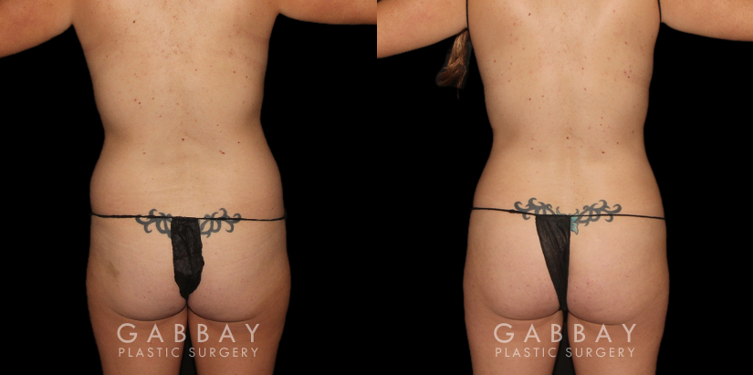 Procedures Depicted:  BBL, Lipo to Abdomen, Waist, and Tailbone, Fat Transfer to Butt.