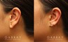 Patient 05 Left Side View Earlobe Repair Gabbay Plastic Surgery