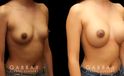 Breast augmentation for younger female patient. Note the pleasing roundness to the breasts that matches her natural body shape well for an attractive enhancement.
