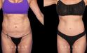 Before and after photos for body procedures, including a tummy tuck and inner thigh liposuction. Combining the procedures resulted in a flatter, smoother abdomen balanced with subtle yet effective tightening of the thighs. The final result evokes a more youthful contour.