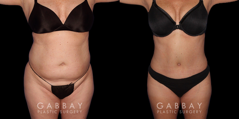 Female patient before and after abdominal liposuction with significant flattening of the stomach area for a refined profile. Patient healed quickly with no complications and maintained her results easily.