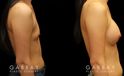 Patient results from breast augmentation, showing the increase from minimal breast size to a round, fuller appearance that suits her body shape.