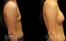 Patient results from breast augmentation, showing the increase from minimal breast size to a round, fuller appearance that suits her body shape.