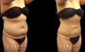Patient’s surgical belly fat removal results reveal significant slimming after her procedure, with virtually no belly overhang for a flat profile contour.