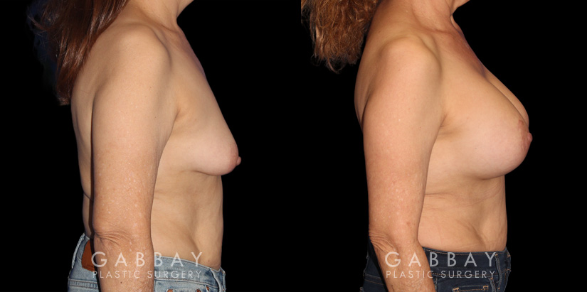 Procedures Depicted:  Breast Augmentation w/ Mastopexy – Silicone