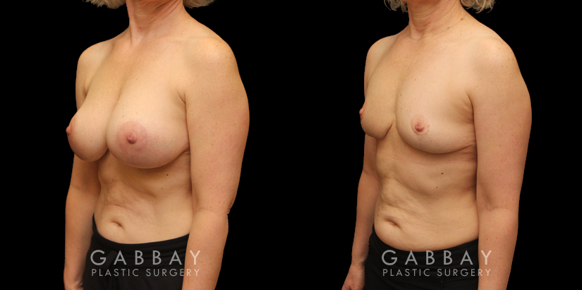 Procedures Depicted:  Auto Augmentation with mesh