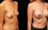 Patient with breast augmentation. Maintained the patient’s natural breast positions while increasing size for a natural look while still improving the aesthetic by boosting volume.