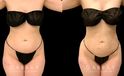 Liposuction results for fat removal along the tailbone, waist, and abdomen, resulting in emphasis of natural curves for a youthful, rejuvenating aesthetic to become visible.