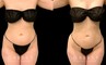Liposuction results for fat removal along the tailbone, waist, and abdomen, resulting in emphasis of natural curves for a youthful, rejuvenating aesthetic to become visible.