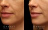Patient 05 3/4th Left Side View Lip Augmentation Gabbay Plastic Surgery