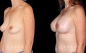 Breast augmentation with increased volume. Note also the improvement to nipple appearance through careful placement of the implants, thus tightening the skin around the nipple for a more aesthetic appearance.