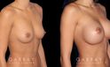 Breast augmentation patient with final results Note the significant increase in breast volume while keeping the shape within natural bounds. Note the absence of visible scarring which is rare with such increases in breast volume.