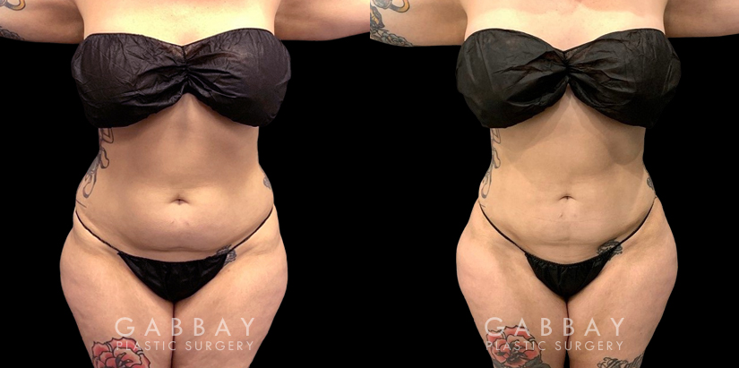 Procedures Depicted:  Abdomen Lipo Female liposuction results for a flatter abdomen. Note how fat reduction was done with her natural figure in mind for results that match her unique features.