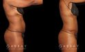 Patient following tummy tuck and hernia repair, showcasing results from multiple angles. Note the absence of stomach overhang in the leaning forward position, demonstrating effective tightening of multiple tissue layers.