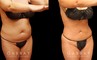 Female liposuction results with significant fat reduction in the abdomen for a tighter appearance while maintaining a natural-looking body contour. Patient recovered quickly and without complications.