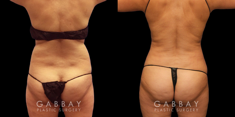 Procedures Depicted:  Liposuction back bra roll