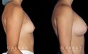 Photos showing patient following complete recovery from breast augmentation with silicone implants. Breast volume increased from minimal size to full, refined volume.