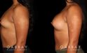 This is a young woman with a tuberous or constricted breast deformity. The lower portion of the breast developed more tightly than the rest of the breast. She wanted a more full, but natural breast appearance. She had silicone breast augmentation, with placement of an Allergan naturelle soft touch silicone breast implant through a lower breast/inframammary fold incision. Her moderate profile implants were 310 cc. Patients like this are prone to lower breast complications such as a double bubble, but with careful performance of the operation, she easily avoided this complication.