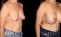 Procedures Depicted:  Breast Augmentation w/ Mastopexy – Silicone