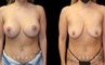 Patient 26 Front View Breast Augpexy Gabbay Plastic Surgery