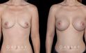 Silicone implants results for female patient in her 30s. Smaller, loose breasts were augmented to a firmer, taut volume with minimal overhang for improved comfort.