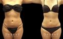 Female patient after liposuction to remove stubborn fat around the stomach and tailbone areas. Patient reported a comfortable and smooth recovery with no complications.