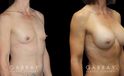 Breast augmentation results for patient with slim and fit body type. The silicone implants were chosen to match this tighter physique for a natural balance.