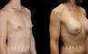 Breast augmentation results for patient with slim and fit body type. The silicone implants were chosen to match this tighter physique for a natural balance.