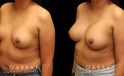Using silicone implants, patient wanted a mild boost to breast volume without dramatic results. The final look has enhanced roundness while keeping to the patient’s natural breast shape and position before the procedure.