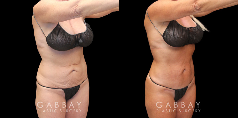 Patient 07 Front View Mini Tummy Tuck Gabbay Plastic Surgery