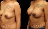 Silicone implant breast augmentation photos showing before and after the procedure (post complete recovery). Patient breasts are demonstrably rounder with a balanced volume increase that suits her body shape.