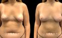 Patient 11 Front View Breast Fat Grafting Gabbay Plastic Surgery