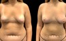 Patient 11 Front View Breast Fat Grafting Gabbay Plastic Surgery