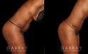 Patient following tummy tuck and hernia repair, showcasing results from multiple angles. Note the absence of stomach overhang in the leaning forward position, demonstrating effective tightening of multiple tissue layers.