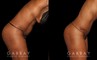Patient following tummy tuck and hernia repair, showcasing results from multiple angles. Note the absence of stomach overhang in the leaning forward position, demonstrating effective tightening of multiple tissue layers.