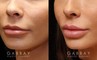 Patient 02 3/4th Left Side View Lip Augmentation Gabbay Plastic Surgery