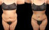 Female patient before-and-after photos for mommy makeover involving 360 liposuction. Note the restored curves around the waist and the flattened abdominal profile with no visible scarring. Patient regained a smooth abdominal area with no evidence of the stretching from pregnancy.
