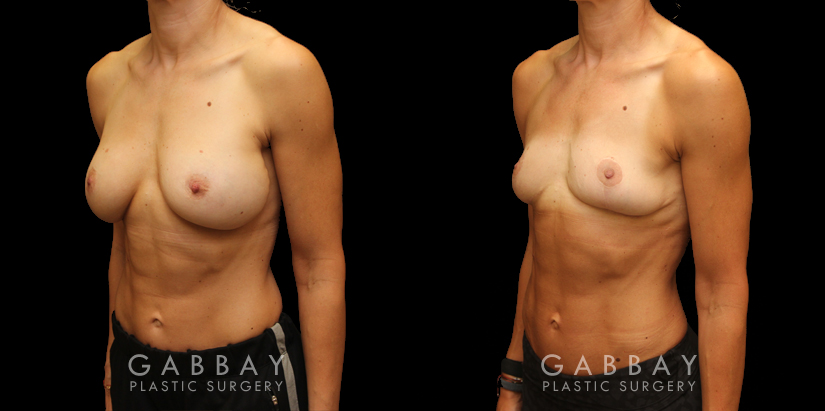 Procedures Depicted:  Implant removal/Mastopexy/Auto Augmentation