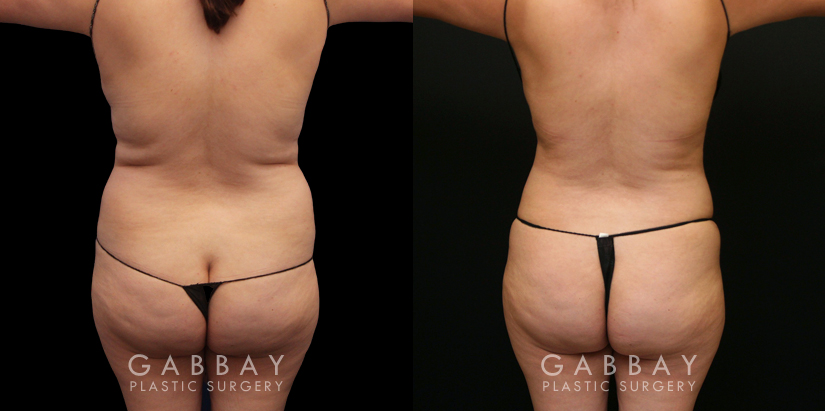 Procedures Depicted:  Lipo to Full Abdomen, Bra Roll and Pubis