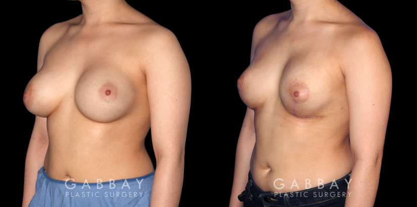 Procedures Depicted:  Breast Augmentation-Remove and Replace Saline & Full Lift