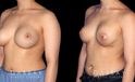 Procedures Depicted:  Breast Augmentation-Remove and Replace Saline & Full Lift