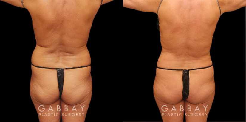 Procedures Depicted:  Breast Aug/Pexy with Liposcution and J-plasma to the Full Abdomen and Upper Back Bra Roll