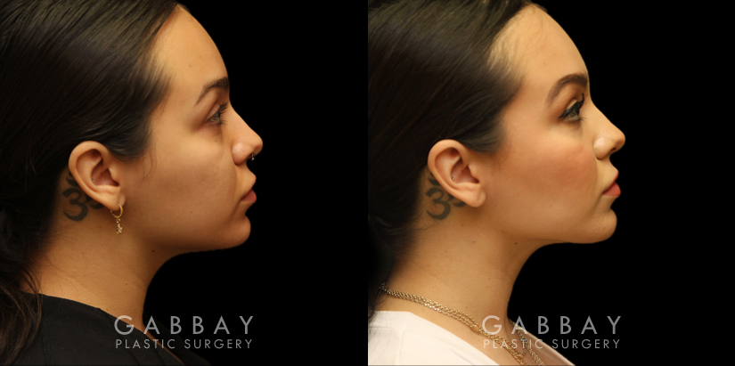 Procedures Depicted:  Buccal Fat Removal with Lipo to Chin